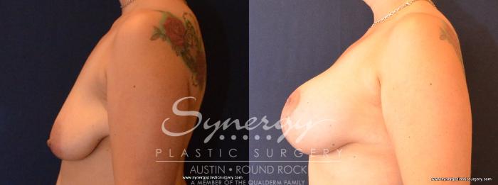 Before & After Breast Lift & Breast Augmentation Case 433 View #4 View in Austin, TX