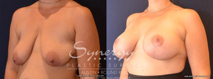 Before & After Breast Lift & Breast Augmentation Case 433 View #5 View in Austin, TX