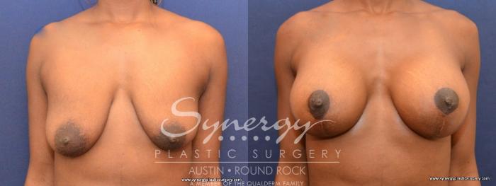 Before & After Breast Lift & Breast Augmentation Case 440 View #1 View in Austin, TX
