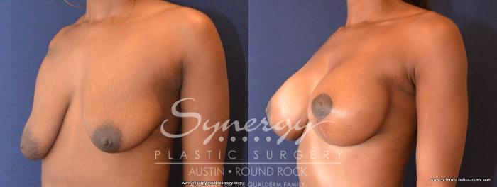 Before & After Breast Lift & Breast Augmentation Case 440 View #2 View in Austin, TX