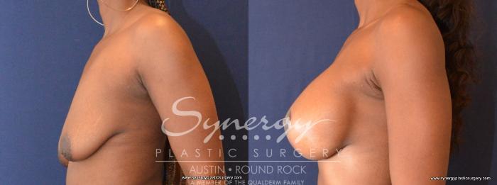 Before & After Breast Lift & Breast Augmentation Case 440 View #3 View in Austin, TX