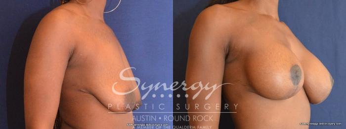 Before & After Breast Lift & Breast Augmentation Case 440 View #4 View in Austin, TX