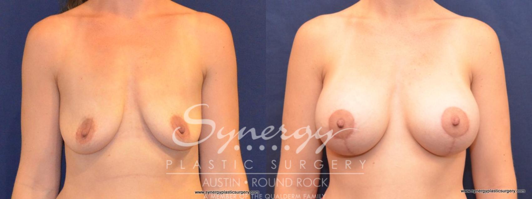 Before & After Breast Lift & Breast Augmentation Case 451 View #1 View in Austin, TX