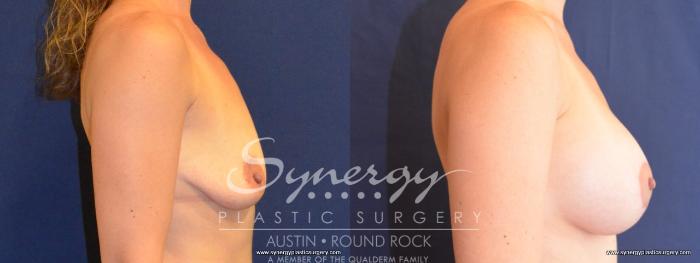 Before & After Breast Lift & Breast Augmentation Case 451 View #2 View in Austin, TX