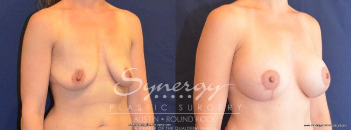 Before & After Breast Lift & Breast Augmentation Case 451 View #3 View in Austin, TX