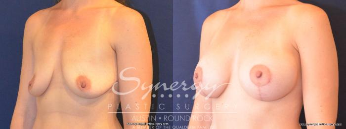 Before & After Breast Lift & Breast Augmentation Case 451 View #5 View in Austin, TX