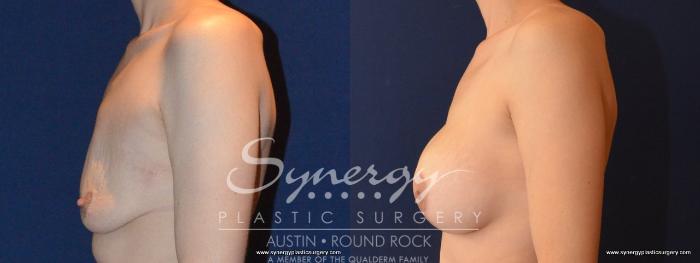 Before & After Breast Lift & Breast Augmentation Case 454 View #2 View in Austin, TX