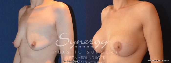 Before & After Breast Lift & Breast Augmentation Case 454 View #3 View in Austin, TX