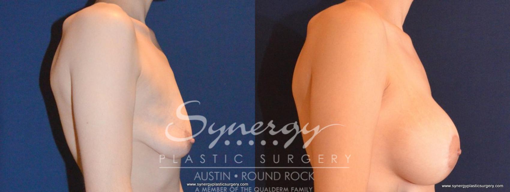 Before & After Breast Lift & Breast Augmentation Case 454 View #4 View in Austin, TX