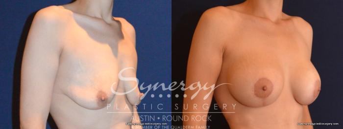 Before & After Breast Lift & Breast Augmentation Case 454 View #5 View in Austin, TX