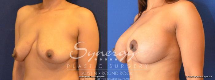 Before & After Breast Lift & Breast Augmentation Case 463 View #2 View in Round Rock, TX