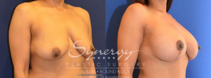 Before & After Breast Lift & Breast Augmentation Case 463 View #3 View in Round Rock, TX