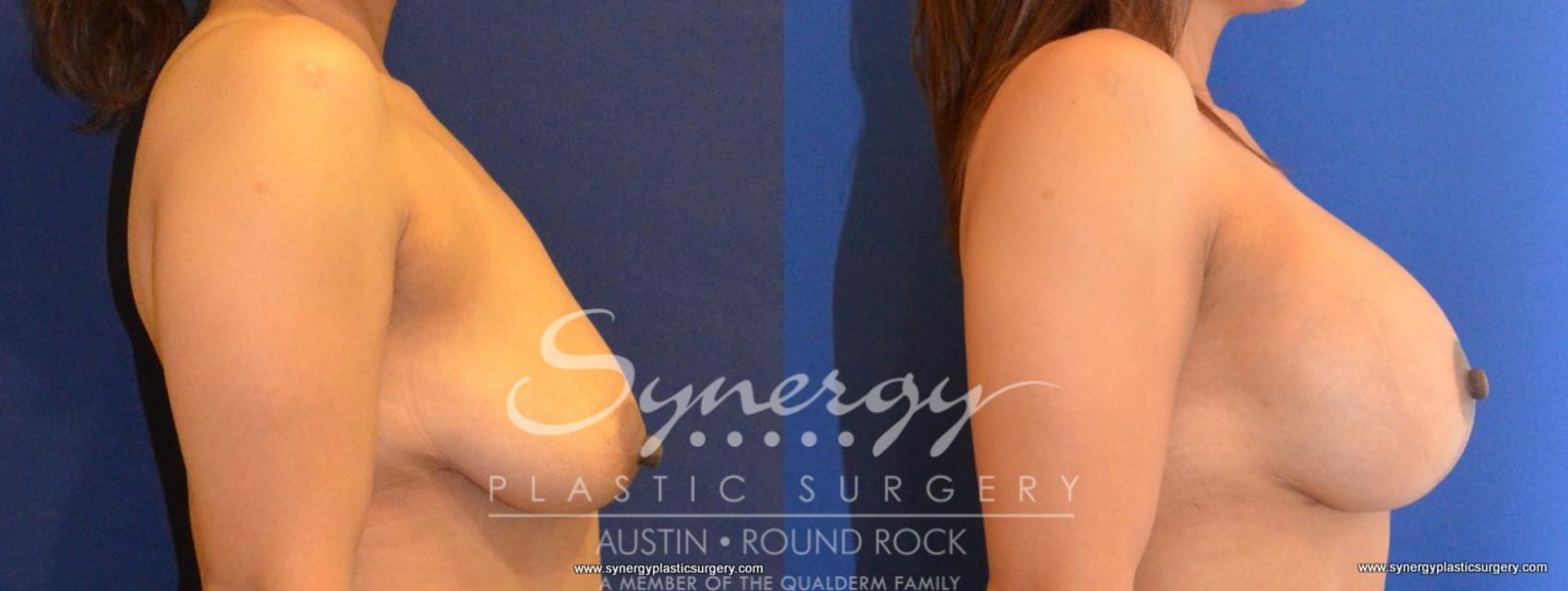 Before & After Breast Lift & Breast Augmentation Case 463 View #4 View in Round Rock, TX