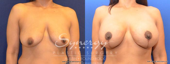 Before & After Breast Lift & Breast Augmentation Case 463 View #5 View in Round Rock, TX