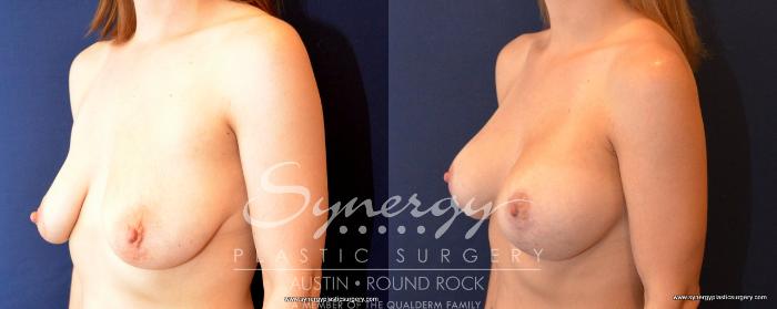 Before & After Breast Lift & Breast Augmentation Case 496 View #2 View in Austin, TX