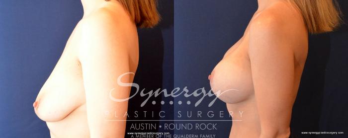 Before & After Breast Lift & Breast Augmentation Case 496 View #3 View in Austin, TX