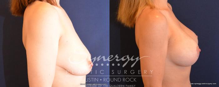 Before & After Breast Lift & Breast Augmentation Case 496 View #5 View in Austin, TX