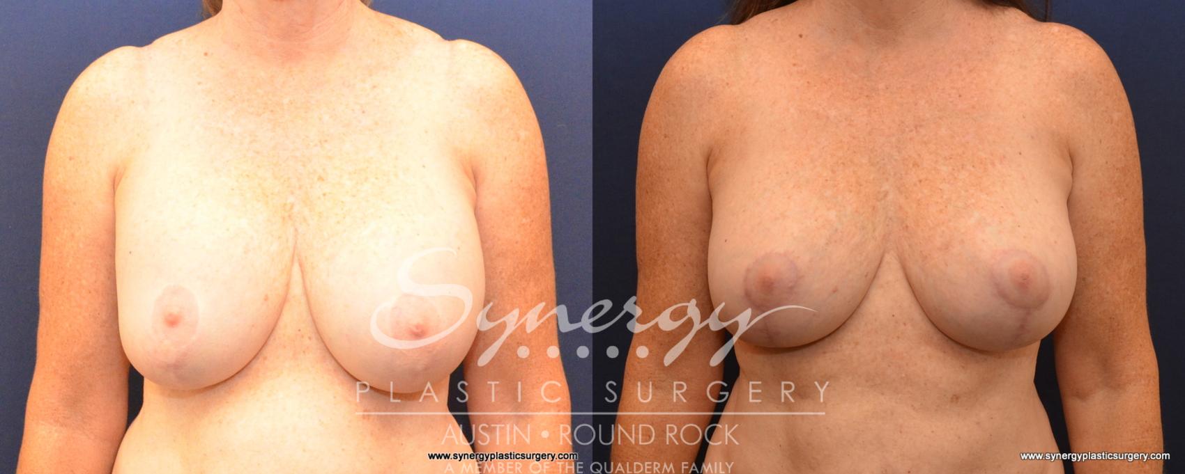 Before & After Breast Lift & Breast Augmentation Case 533 View #1 View in Austin, TX