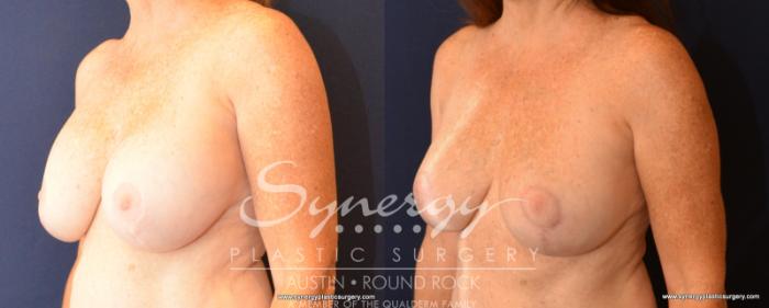Before & After Breast Lift & Breast Augmentation Case 533 View #2 View in Austin, TX