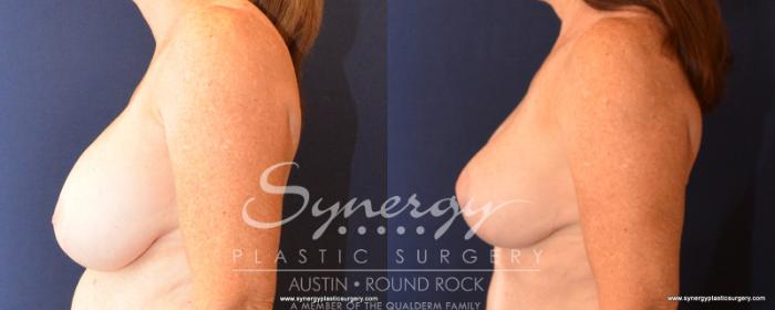 Before & After Breast Lift & Breast Augmentation Case 533 View #3 View in Austin, TX