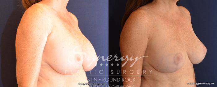 Before & After Breast Lift & Breast Augmentation Case 533 View #4 View in Austin, TX