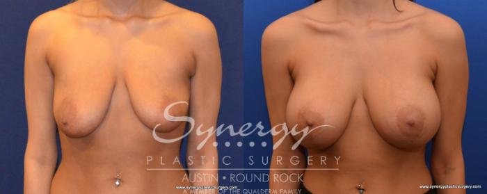 Before & After Breast Lift & Breast Augmentation Case 536 View #1 View in Austin, TX