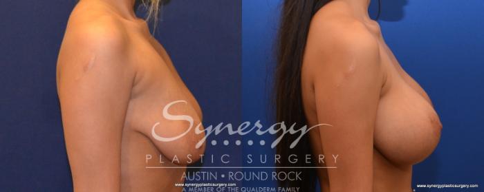 Before & After Breast Lift & Breast Augmentation Case 536 View #2 View in Austin, TX