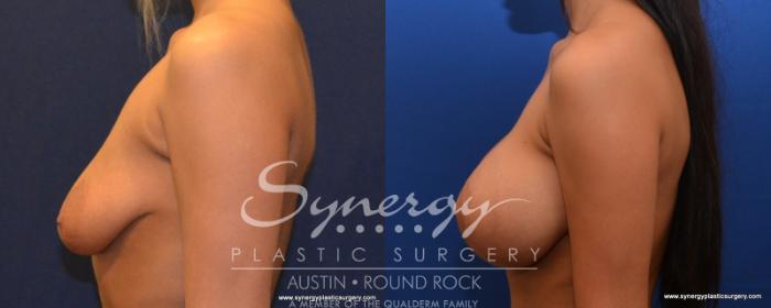 Before & After Breast Lift & Breast Augmentation Case 536 View #3 View in Austin, TX