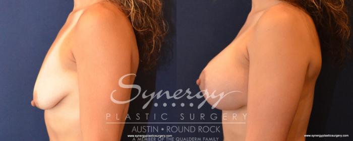 Before & After Breast Lift & Breast Augmentation Case 548 View #3 View in Austin, TX