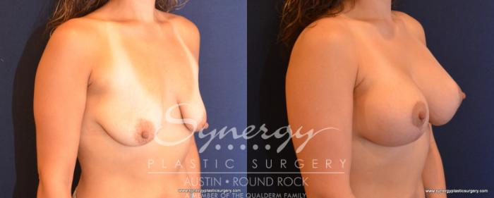 Before & After Breast Lift & Breast Augmentation Case 548 View #4 View in Austin, TX