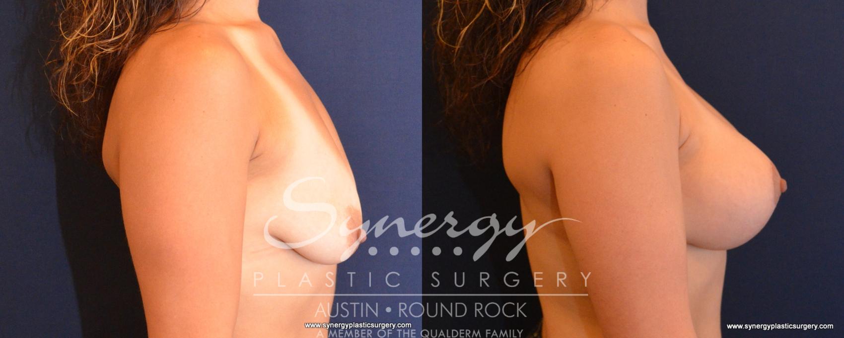 Before & After Breast Lift & Breast Augmentation Case 548 View #5 View in Austin, TX