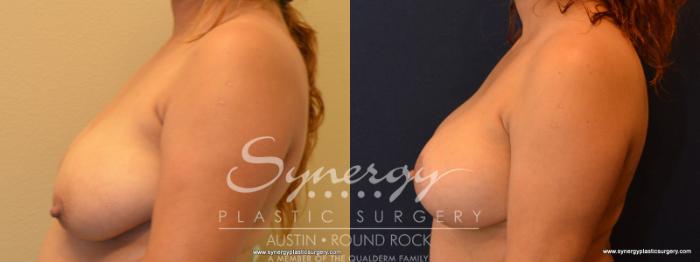 Before & After Breast Lift & Breast Augmentation Case 550 View #1 View in Austin, TX