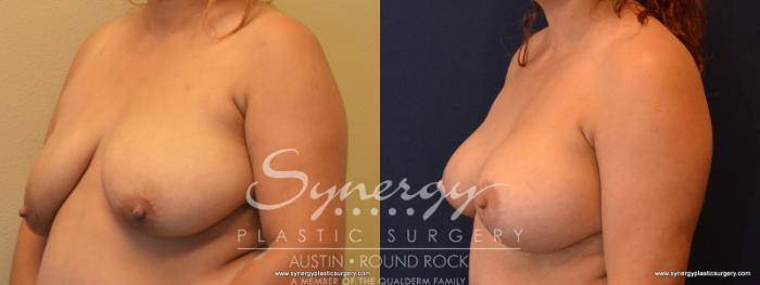 Before & After Breast Lift & Breast Augmentation Case 550 View #2 View in Austin, TX