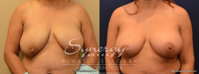 Before & After Breast Lift & Breast Augmentation Case 550 View #3 View in Austin, TX