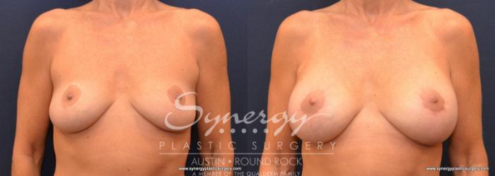 Before & After Breast Lift & Breast Augmentation Case 579 View #1 View in Austin, TX