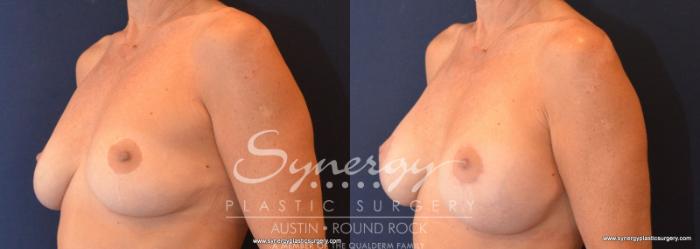 Before & After Breast Lift & Breast Augmentation Case 579 View #2 View in Austin, TX