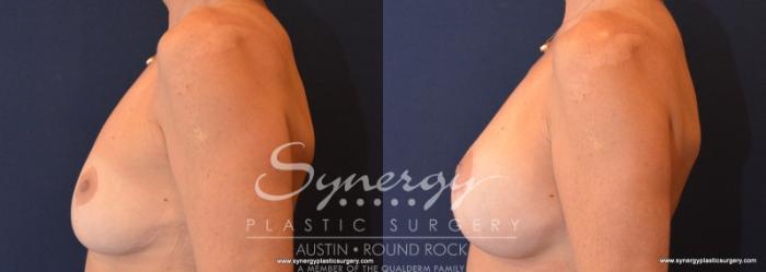 Before & After Breast Lift & Breast Augmentation Case 579 View #3 View in Austin, TX