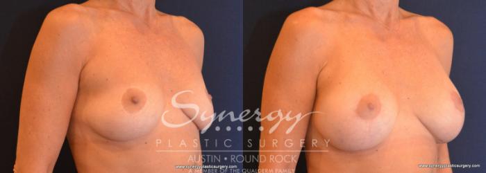 Before & After Breast Lift & Breast Augmentation Case 579 View #4 View in Austin, TX
