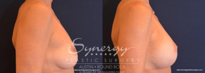 Before & After Breast Lift & Breast Augmentation Case 579 View #5 View in Austin, TX