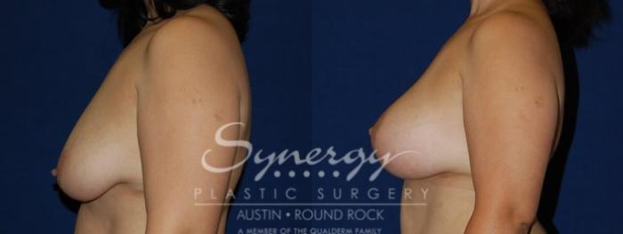 Before & After Breast Lift & Breast Augmentation Case 58 View #1 View in Austin, TX