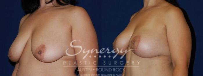 Before & After Breast Lift & Breast Augmentation Case 58 View #3 View in Austin, TX