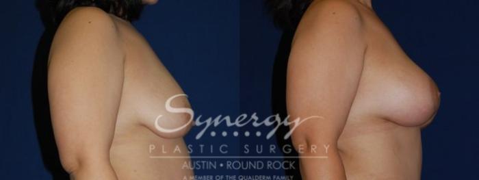 Before & After Breast Lift & Breast Augmentation Case 58 View #4 View in Austin, TX