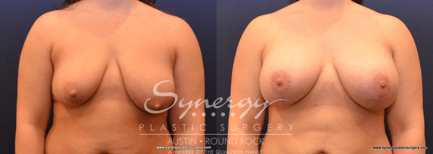 Before & After Breast Lift & Breast Augmentation Case 588 View #1 View in Austin, TX