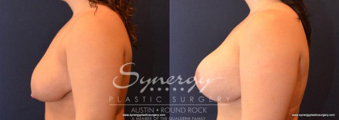 Before & After Breast Lift & Breast Augmentation Case 588 View #3 View in Austin, TX