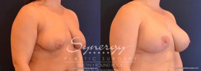 Before & After Breast Lift & Breast Augmentation Case 588 View #4 View in Austin, TX
