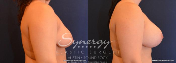 Before & After Breast Lift & Breast Augmentation Case 588 View #5 View in Austin, TX