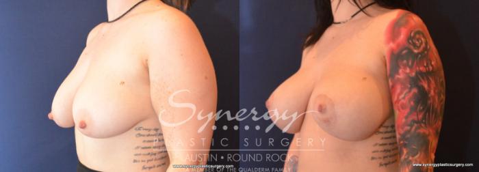 Before & After Breast Lift & Breast Augmentation Case 594 View #2 View in Austin, TX