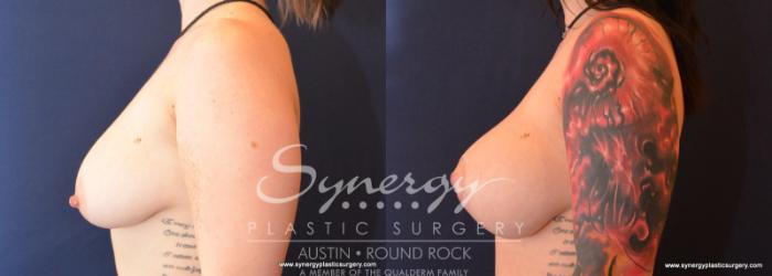 Before & After Breast Lift & Breast Augmentation Case 594 View #3 View in Austin, TX