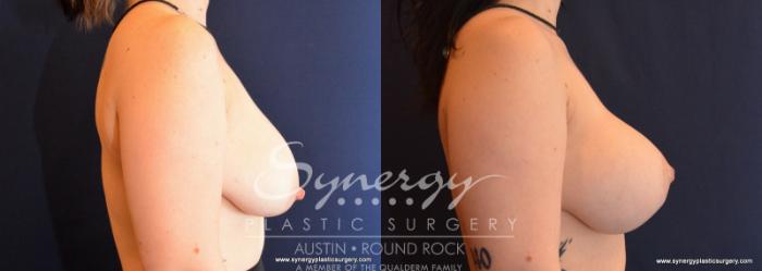 Before & After Breast Lift & Breast Augmentation Case 594 View #4 View in Austin, TX