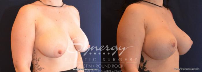 Before & After Breast Lift & Breast Augmentation Case 594 View #5 View in Austin, TX
